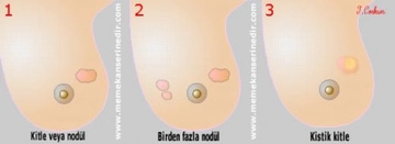 Memede Ağrılı Kitle Belirtileri ve Tedavisi