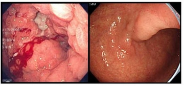 Midede Kitle Belirtileri ve Tedavisi